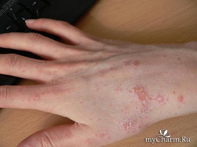 Заболевания кожи рук и ногтей 41