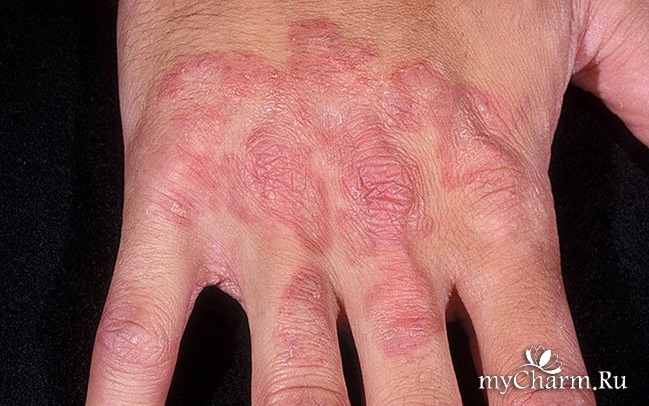 Заболевания кожи рук и ногтей 45