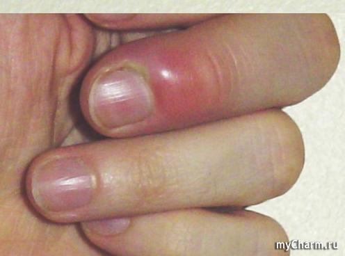 Заболевания кожи рук и ногтей 47