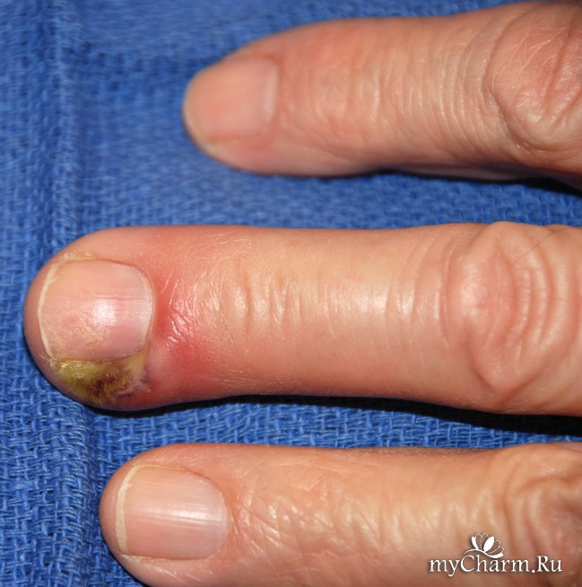 Заболевания кожи рук и ногтей 49